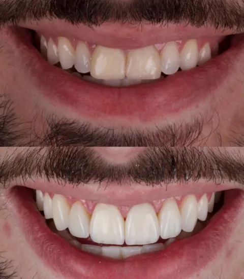 Antes e depois de facetas: correção de forma, cor e alinhamento