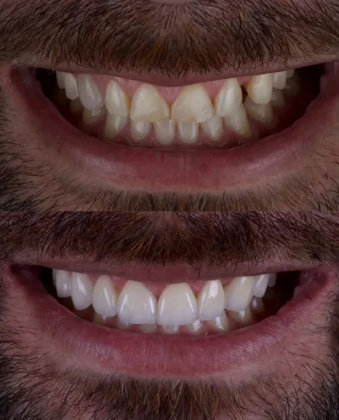 Antes e depois de facetas em porcelana