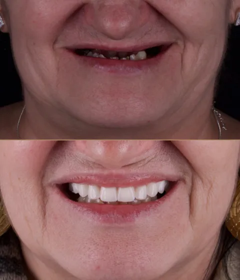 Antes e depois de reabilitação oral com prótese