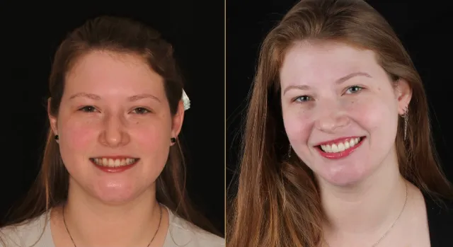 Antes e depois de facetas com adaptação digital