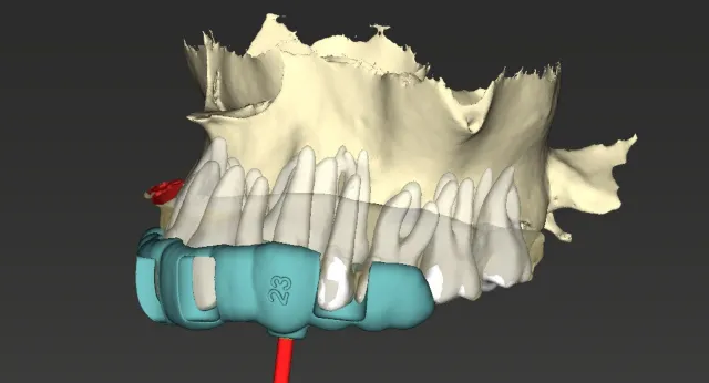 Planejamento digital de guia para endodontia guiada
