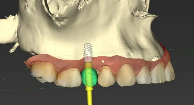 Planejamento digital 3D de implante com guia cirúrgico para cirurgia guiada